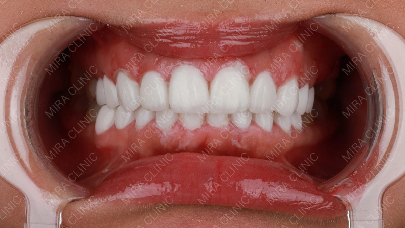patients with veneers experience 